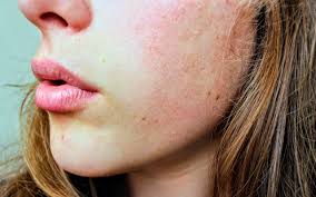 Could Dry Skin Be Related to Your Hormones? - Pro-Pell Therapy Program