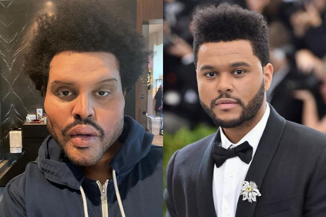  Shokon The Weeknd, operacioni plastik i shkatërron fytyrën