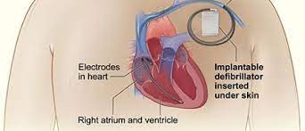 Implantable cardioverter defibrillators - your questions answered - Latest  news - Cardiomyopathy UK