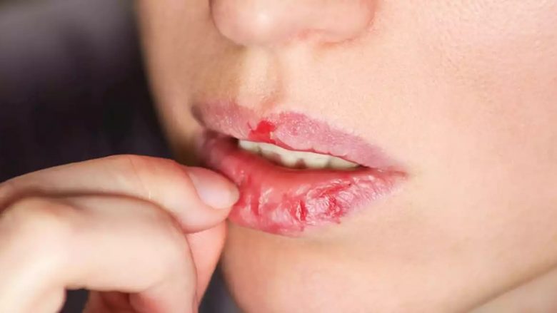  Këto 3 ushqime ndikojnë që buzët tuaja të thahen