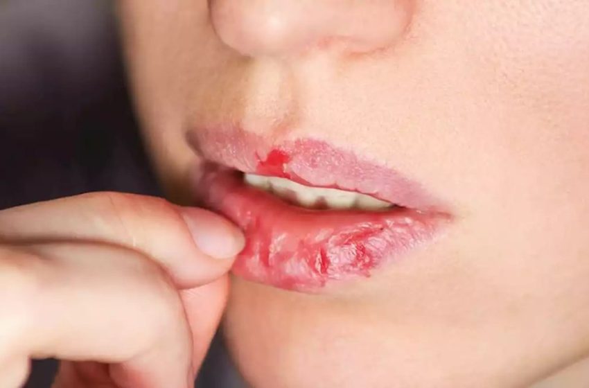  Keni problem me buzët e plasaritura gjatë dimrit? Këto metodat natyrale do t’ju shpëtojnë